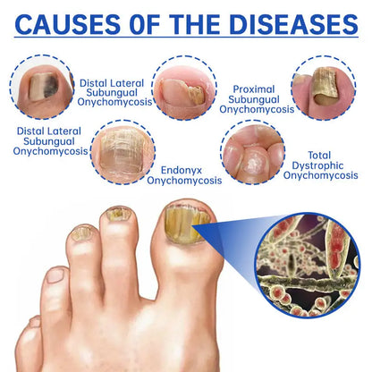 Dispositivo de terapia láser para hongos