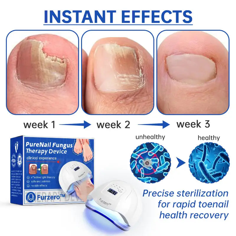 Fungus Laser Therapy Device