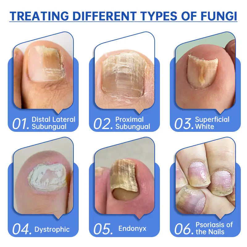 Dispositivo de terapia láser para hongos