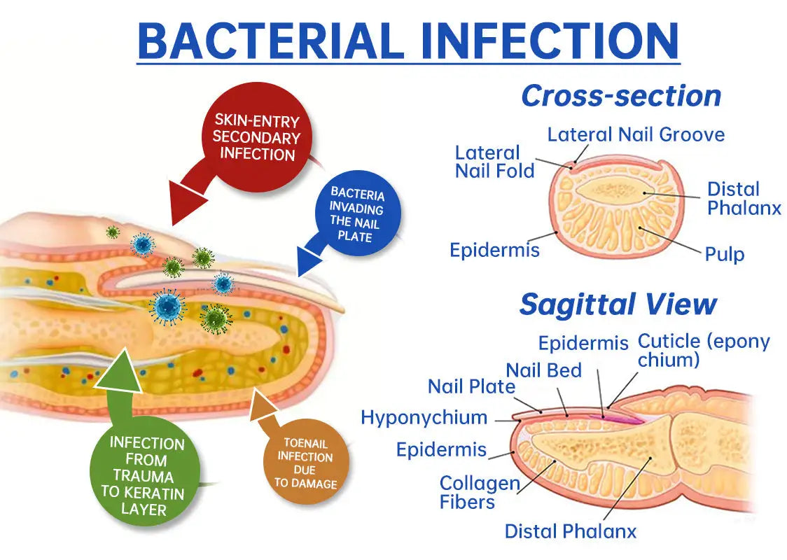 Fungus Laser Therapy Device WEM Support (www.WEM.support)